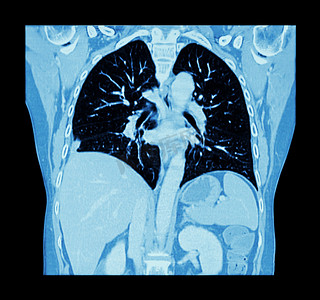 新型冠状病毒感染预防要点摄影照片_肺癌 （胸部和腹部 Ct 扫描 ： 显示右肺癌 ） （ 冠状平面 )