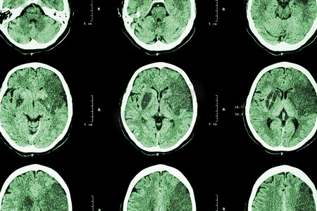 绿色科技医疗摄影照片_缺血性中风：（脑Ct显示左前脑梗死- 时间-腹腔）（神经系统背景） )