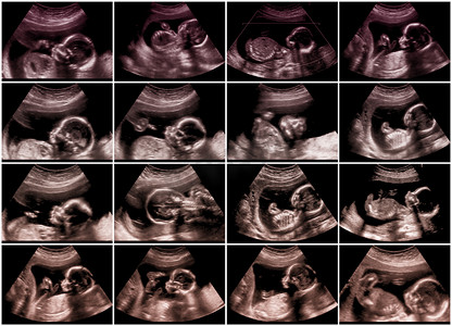 16 超声胎儿图片拼贴
