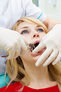 医生牙医用止血钳去除患者牙执行提取过程