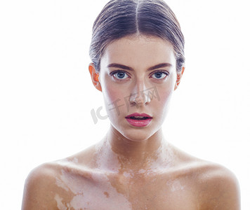 beautiful young brunette woman with vitiligo disease isolated on white positive smiling, model problems concept, bad tan real problem