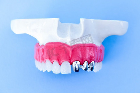 牙种植体和牙冠安装过程隔离在蓝色背景上。医学上精确的3D插图