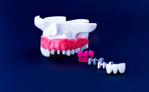 牙种植体和牙冠安装过程隔离在蓝色背景上。医学上精确的3D插图
