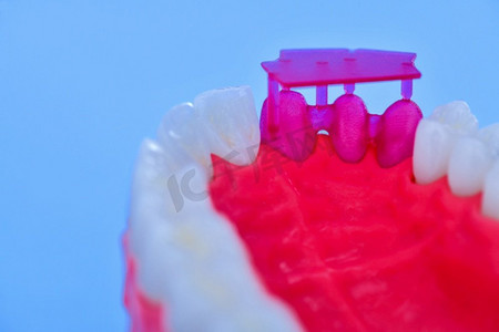 手术摄影照片_牙种植体和牙冠安装过程隔离在蓝色背景上。医学上精确的3D插图