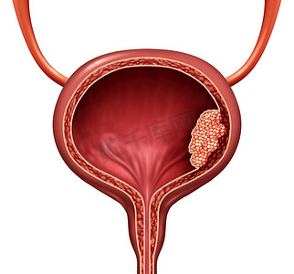 人类膀胱癌作为一种泌尿系统解剖器官疾病，以恶性细胞的概念作为人体解剖的3D插图。