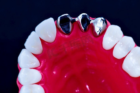 牙齿种植和冠安装过程孤立在蓝色背景。医学上精确的3D插图