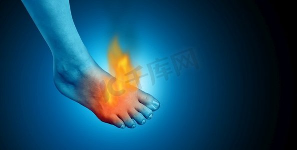 疼痛的脚和脚疼痛作为疼痛的炎症的足病学符号与3D例证元素在蓝色背景。