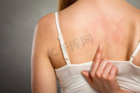 女人舒雅摄影照片_ 皮肤，湿疹，女人，颈部