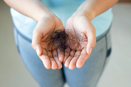 女性对洗发水过敏导致脱发