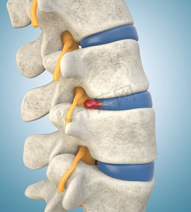 人体腰椎模型显示椎间盘突出,压迫神经根导致背部疼痛.