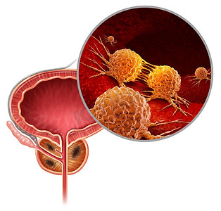 肿瘤细胞动漫图摄影照片_前列腺，解剖，背景，肿瘤