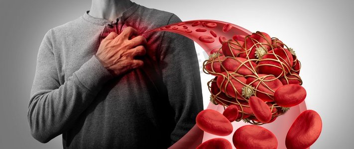 被粘性血小板和纤维蛋白聚集在一起,作为通向心脏的动脉或静脉的阻塞