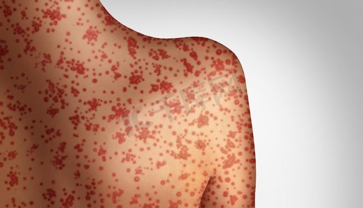 麻疹概念作为致命的爆发免疫，疾病和病毒性疾病作为传染性水痘或皮疹在3D插图风格。