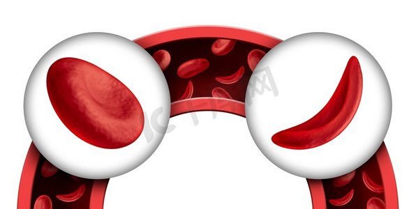 线条插图gif摄影照片_镰状细胞贫血作为一个正常的和异常的血红蛋白解剖医学插图概念在3D渲染。