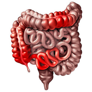 克隆氏病？？S病或克隆氏病的医学概念为人体肠道出现炎症症状，造成肠梗阻，作为3D插图。