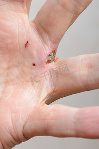 一名男子被狗咬伤了手。手指间的獠牙留下的深深伤口很明显。