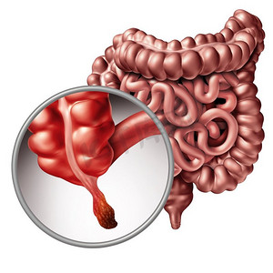 阑尾炎和阑尾炎疾病的概念作为人体肠道解剖的特写作为3D插图。