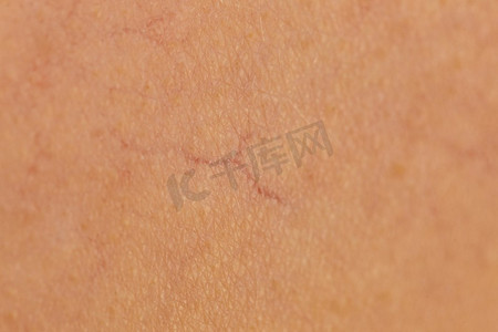 皮肤斑点摄影照片_ 皮肤病，皮肤，静脉，斑点