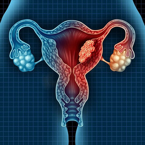 妇科疾病摄影照片_子宫内膜、癌、子宫内膜、不孕症