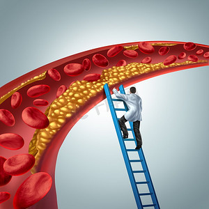 梯梯摄影照片_胆固醇医学诊断概念：医生使用3D渲染元素调查动脉粥样硬化或阻塞动脉的动脉斑块。