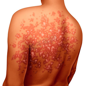 人类的皮肤摄影照片_牛皮癣疾病和自身免疫性疾病作为患者身上的干红皮肤斑块，作为皮肤科疾病的象征，在3D插图风格中。