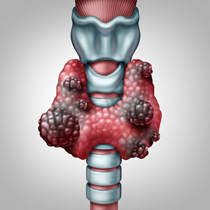 甲状腺、腺体、癌症、癌症