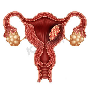 子宫内膜、癌症、不孕症、子宫