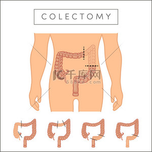 low背景背景图片_图类型的结肠切除术 