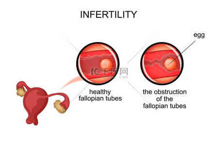 妇产科背景图片_uterus.infertility 由于输卵管梗阻