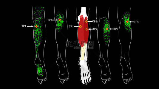 小牛的肌肉 腿上的触发点，反映了大腿后部和脚部的疼痛。 腿疼