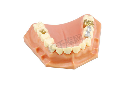 牙科模型（不同治疗）