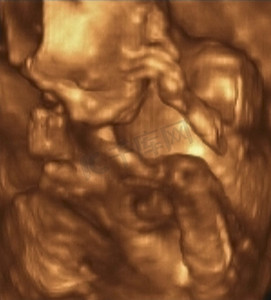 意大利第 4 个月胎儿的超声回波描记术