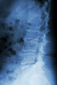 侧行摄影照片_胶片 X 射线腰椎侧向：显示腰椎爆裂骨折
