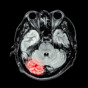 MRI 大脑：显示大脑的下部（小脑，颞叶）