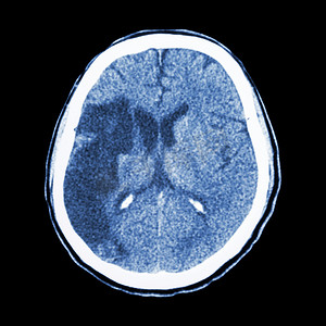 CT 大脑：显示缺血性中风（右额 pa 低密度
