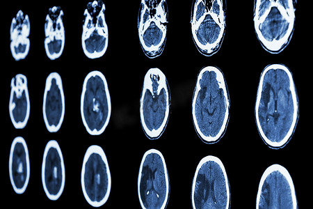 大脑的胶片 CT 扫描显示缺血性中风和出血性中风