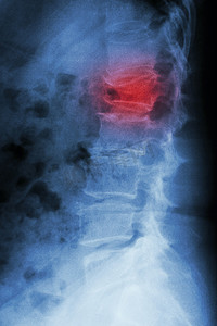胶片 X 射线腰椎侧向：显示腰椎爆裂骨折