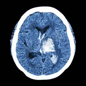 CT 大脑：显示左丘脑出血（出血性中风）
