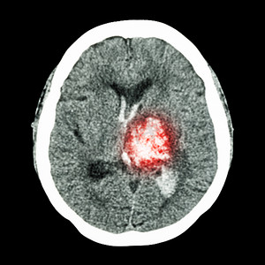 CT 大脑：显示左丘脑出血（出血性中风）