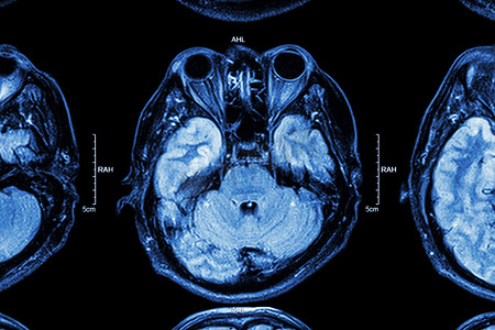 电影震撼片头摄影照片_关闭 MRI 大脑：大脑的​​下部（眼睛，颞 lo