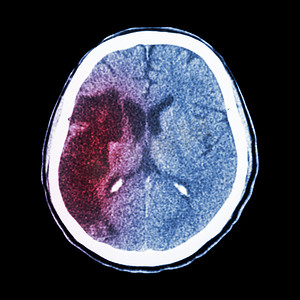 脑中风种类摄影照片_CT 大脑：显示缺血性中风（右额 pa 低密度