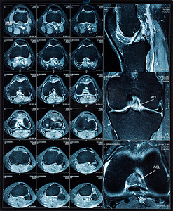 膝关节磁共振断层扫描 (MRT) 图像