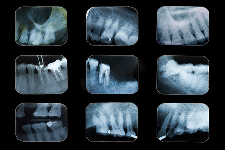 光白色放射摄影照片_检查牙齿，黑色背景上的多牙科 X 光片。