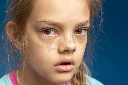 眼睛炎症摄影照片_十岁女孩眼前的结膜炎