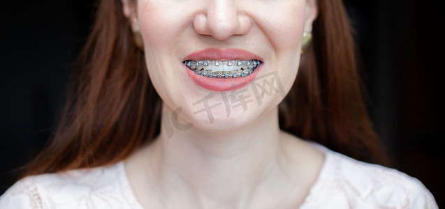 洁白的牙齿上带着牙套的年轻女孩的笑容。