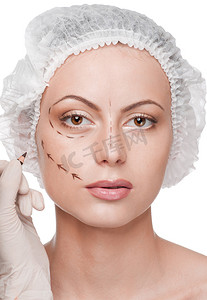 女性面部矫正线，手术前