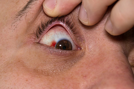 结膜摄影照片_眼睛受伤，年轻人眼睛血管爆裂，疲劳，血管问题