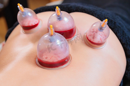 hijama 师傅为一名年轻女孩进行真空吸血手术。