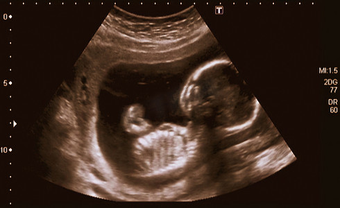 胎儿发育图摄影照片_第 4 个月胎儿的超声检查分析