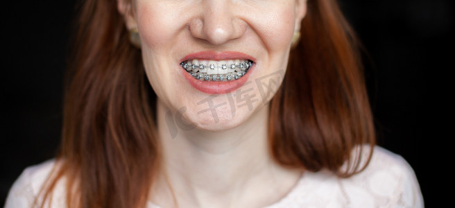 洁白的牙齿上带着牙套的年轻女孩的笑容。